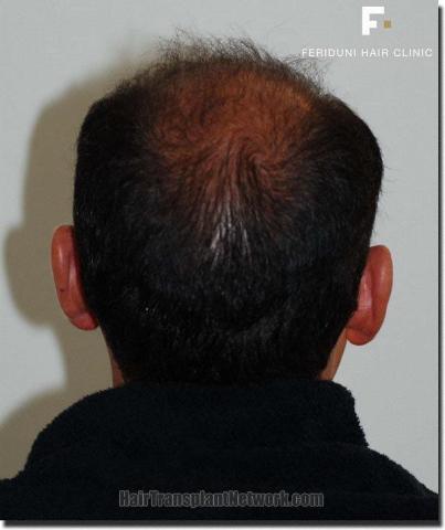 Hair restoration procedure results