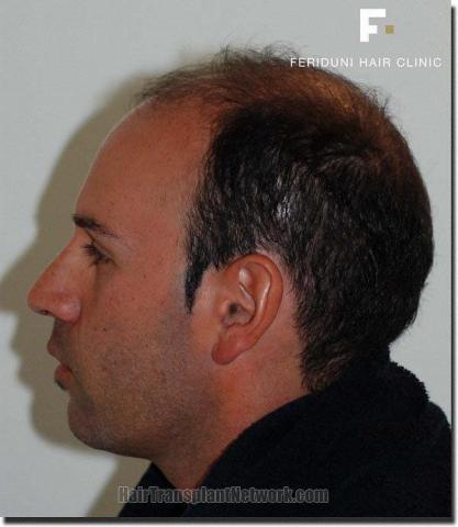 Hair restoration procedure results