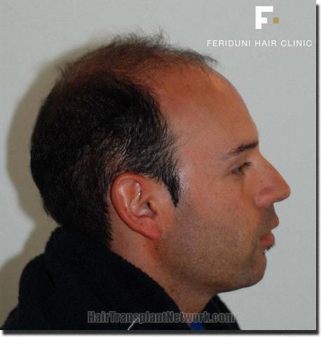 Hair restoration procedure results