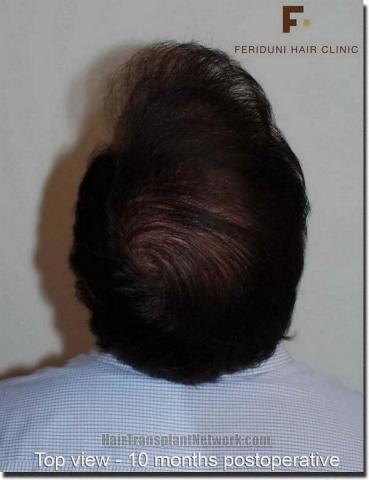 Hair restoration procedure results