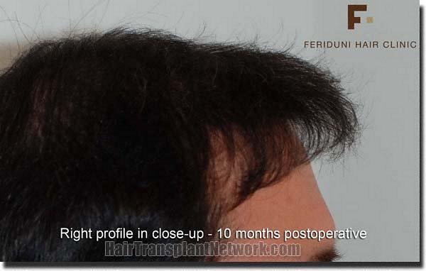 Hair restoration procedure results