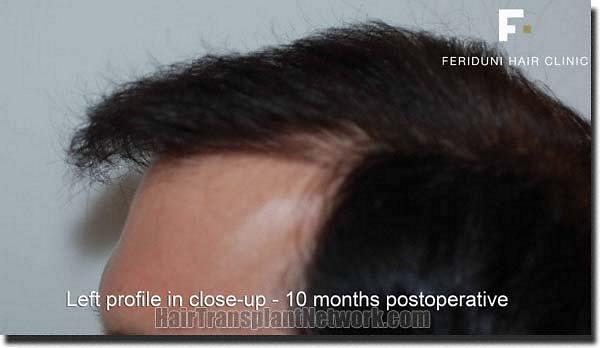 Hair restoration procedure results