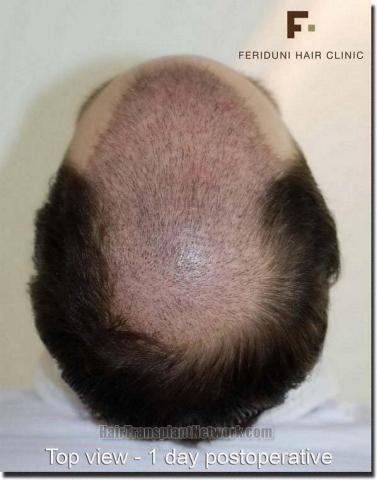 Hair restoration procedure results