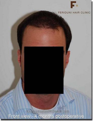 Hair restoration procedure results