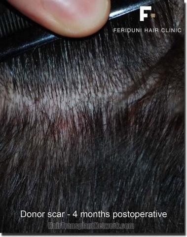 Hair restoration procedure results