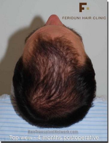 Hair restoration procedure results