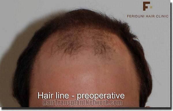 Hair restoration procedure results