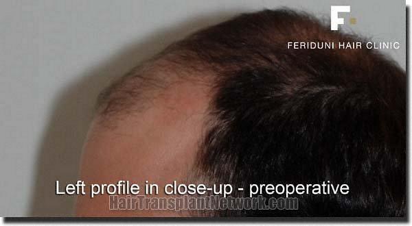 Hair restoration procedure results