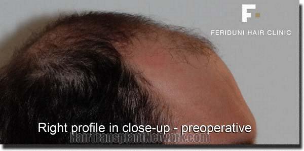 Hair restoration procedure results