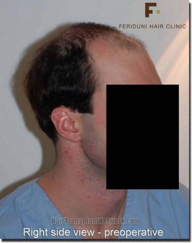 Hair restoration procedure results