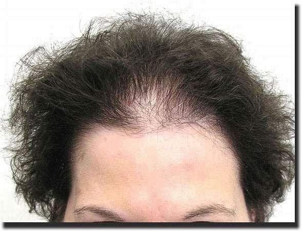 Hair restoration procedure results