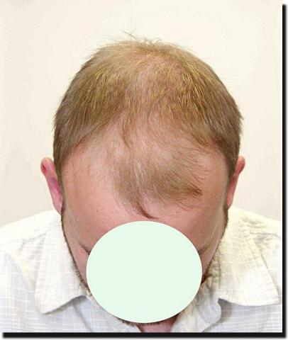 Hair restoration procedure results