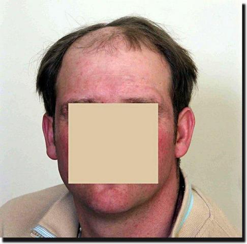 Hair restoration procedure results