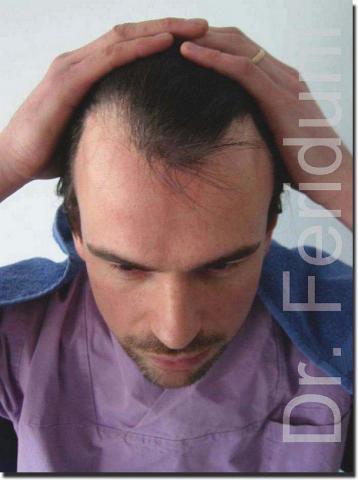 Hair restoration procedure results