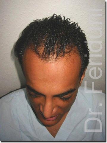 Hair restoration procedure results