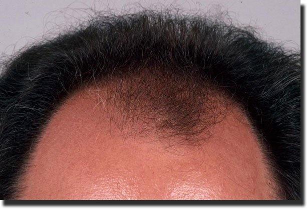 Hair restoration procedure results