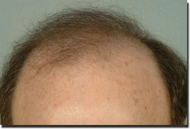 Hair restoration procedure results