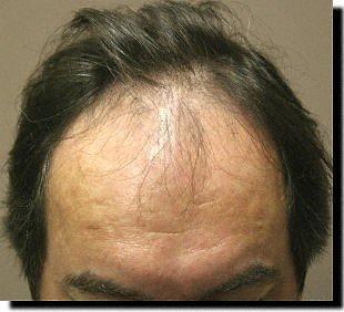 Hair restoration procedure results