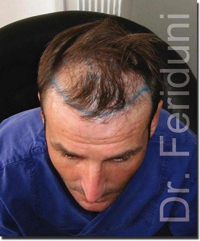 Hair restoration procedure results