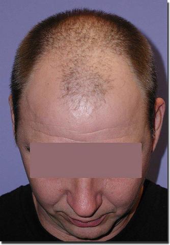 Hair restoration procedure results