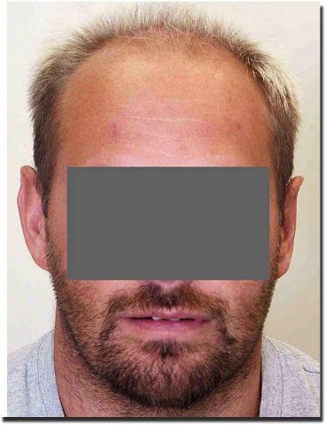 Hair restoration procedure results