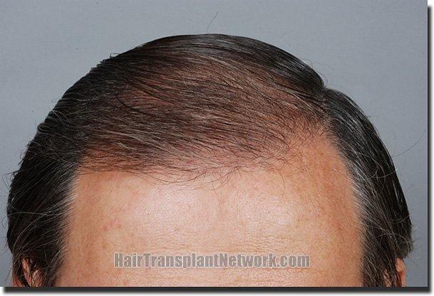 Hair restoration procedure results