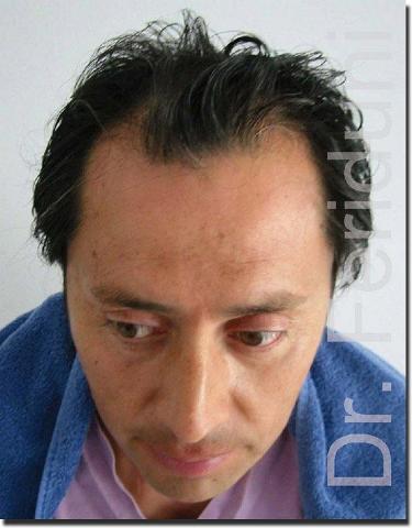 Hair restoration procedure results