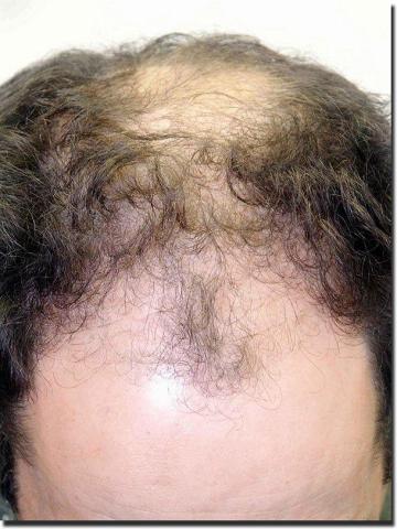 Hair restoration procedure results