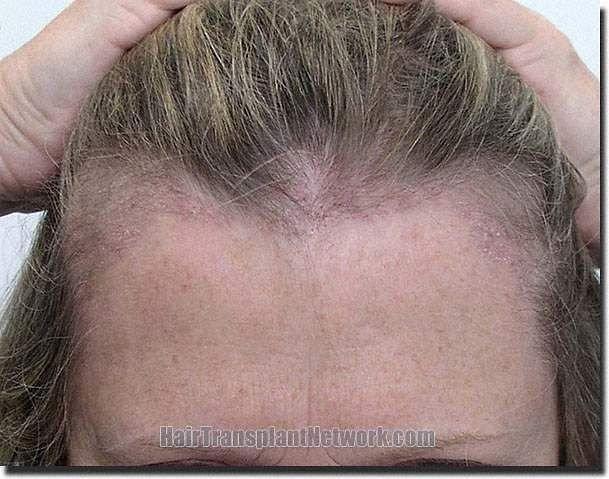 Hair restoration procedure results