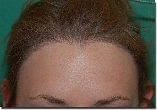 Hair restoration procedure results