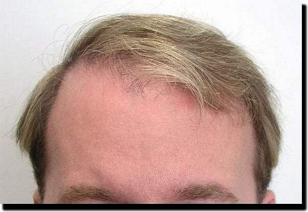 Hair restoration procedure results