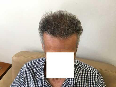 Frontal hairline after 2800 FUE grafts by Dr Christina