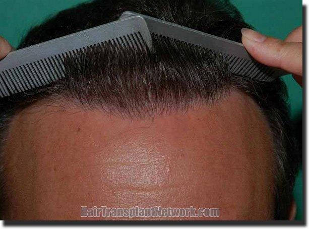 Hair restoration procedure results