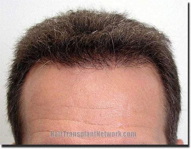 Hair restoration procedure results