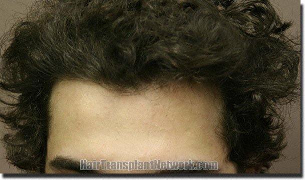 Hair restoration procedure results