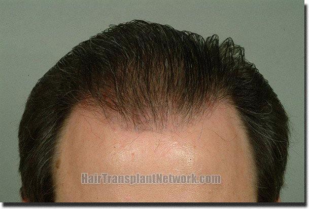 Hair restoration procedure results