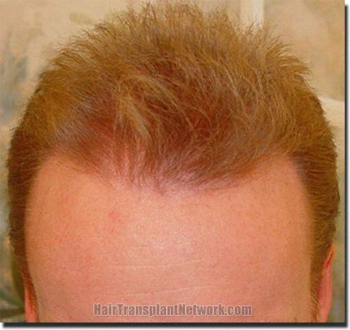 Hair restoration procedure results