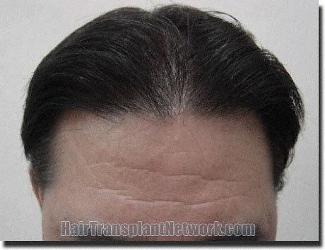 Hair restoration procedure results