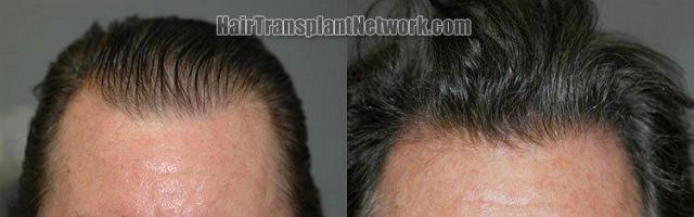 Front view of hair transplant, before and after