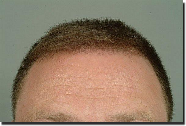 Hair restoration procedure results