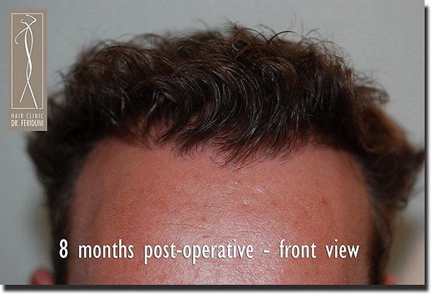 Hair restoration procedure results