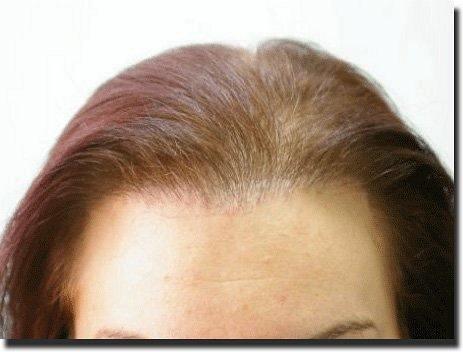 Hair restoration procedure results