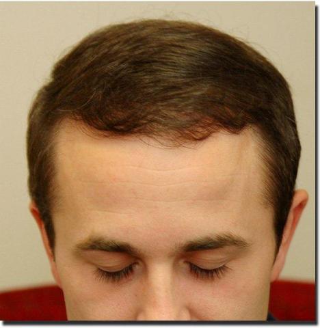 Hair restoration procedure results