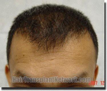 Hair restoration procedure results