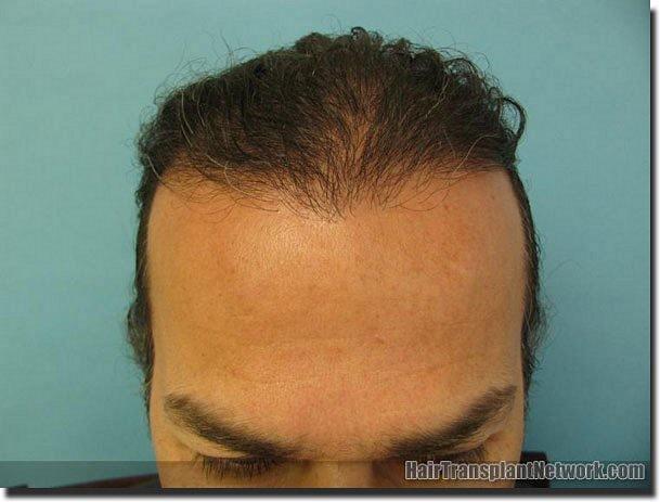 Hair restoration procedure results