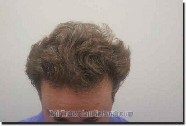 Hair restoration procedure results