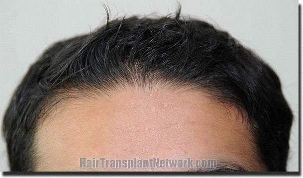 Hair restoration procedure results