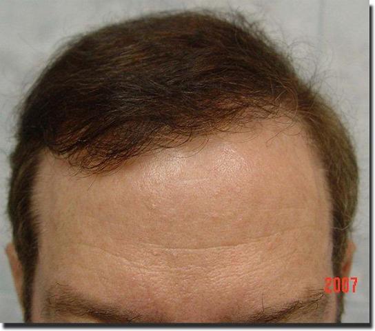 Hair restoration procedure results