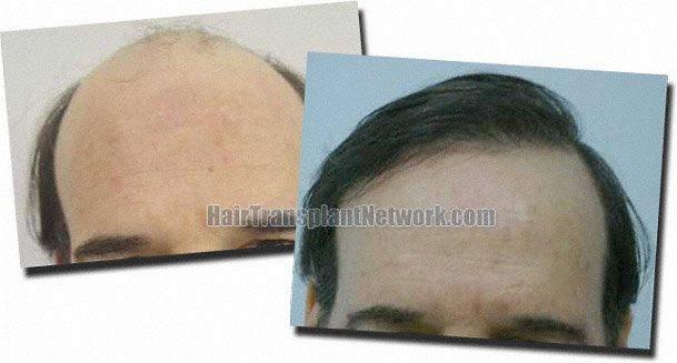 Hair restoration procedure results