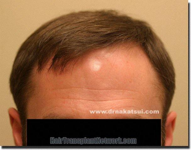 Hair restoration procedure results